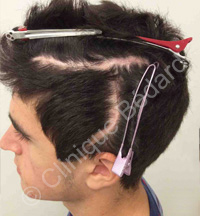 Hair transplant man before