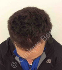hair transplant man result after