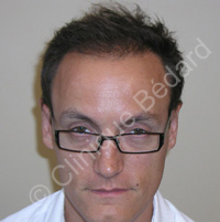 hair transplant man result after