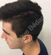 hair transplant man result after