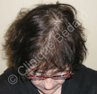 hair transplant woman result after