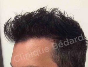 FUE 800 grafts Technique after