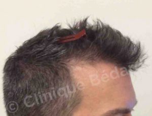 FUE 800 grafts Technique before