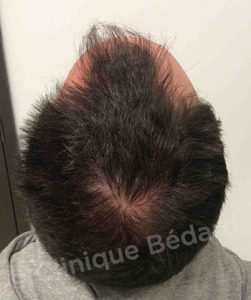 back FUE 1440 Grafts Technique before