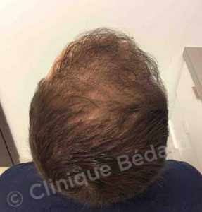 back Strip 1440 Grafts Technique after