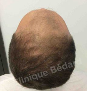 back Strip 1440 Grafts Technique before