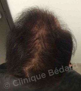 back Strip 1250 Grafts Technique after