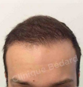 face Strip 1440 Grafts Technique after