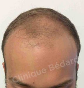 face Strip 1440 Grafts Technical before