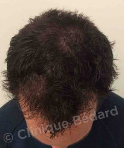 top FUE 1440 Grafts Technique after