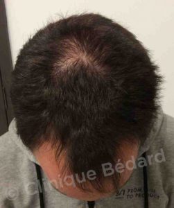 top FUE 1440 Grafts Technique before