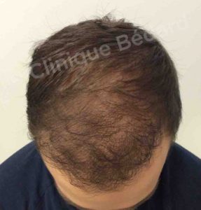 top Strip 1440 Grafts Technique after