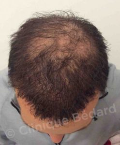 top Strip 1080 Grafts Technique after