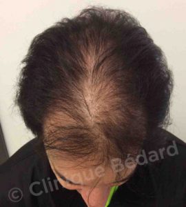 top Strip 1250 Grafts Technique before